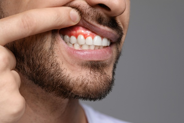 How Gum Disease Treatment Stops Symptoms In Their Tracks And Protects Your Oral Health